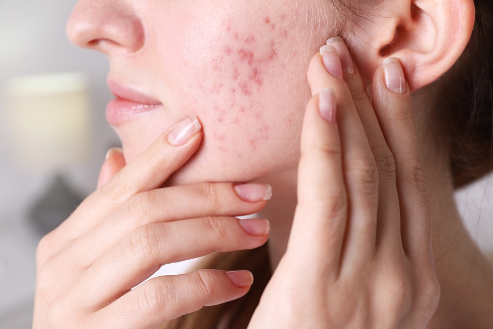 Read more about the article Your Quick Guide to Choosing the Best Acne Treatments in Bridgton, Maine
