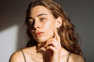 Read more about the article 7 Signs to See the Best Acne Doctor in Bridgton, Maine