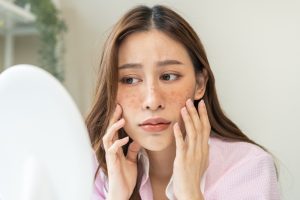 Read more about the article Say Goodbye to Stubborn Spots With the Best Dark Spot Treatment in Bridgton, Maine
