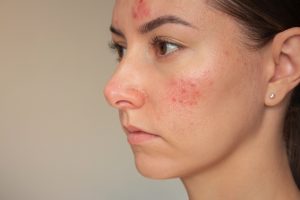 Read more about the article 20 Questions You Should Ask at Your Acne Appointment in Bridgton, Maine