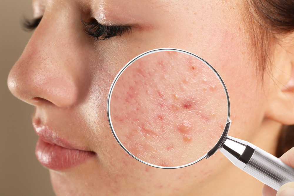 Read more about the article Here’s How to Find an Acne Specialist in Lewiston, Maine
