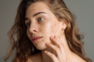 Read more about the article Best Acne Doctor Near Lewiston, Maine