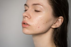 Read more about the article Acne Appointment Near Lewiston, Maine